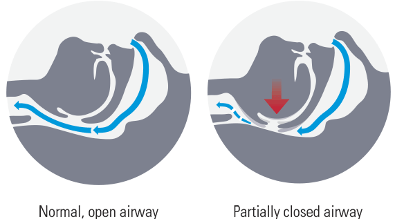 airway